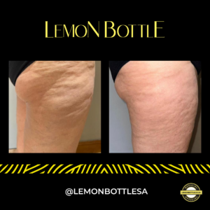 Fat Dissolving injections